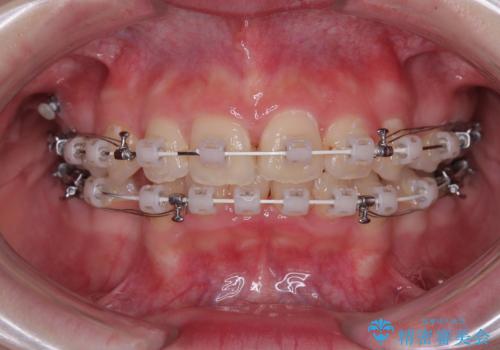 【モニター】デコボコと隠れてしまう前歯 ワイヤー装置による抜歯矯正で美しい口元にの治療中