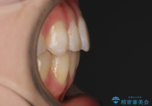 【非抜歯】インビザラインの短期治療の治療後