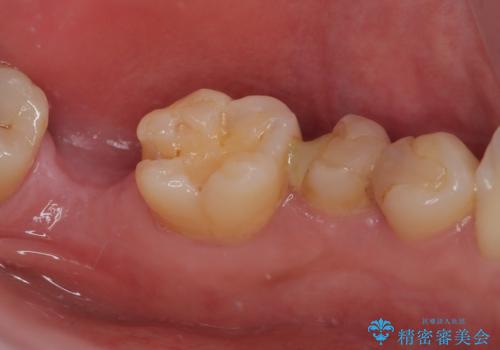 詰め物が外れかけてるのでやり替えたい セラミックインレー修復・フルジルコニアクラウンの治療前