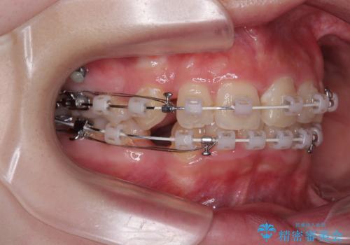 【モニター】デコボコと隠れてしまう前歯 ワイヤー装置による抜歯矯正で美しい口元にの治療中