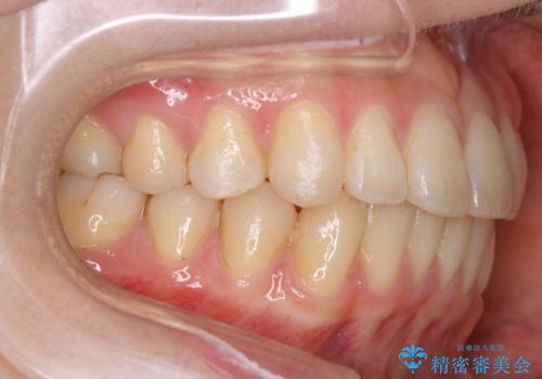 【非抜歯】インビザラインの短期治療の治療後