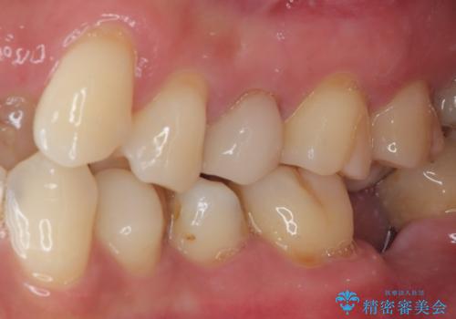 詰め物が外れかけてるのでやり替えたい セラミックインレー修復・フルジルコニアクラウンの治療前