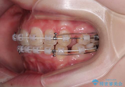 【モニター】デコボコと隠れてしまう前歯 ワイヤー装置による抜歯矯正で美しい口元にの治療中