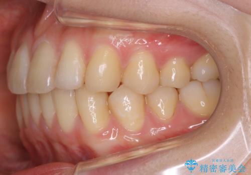 【非抜歯】インビザラインの短期治療の治療後