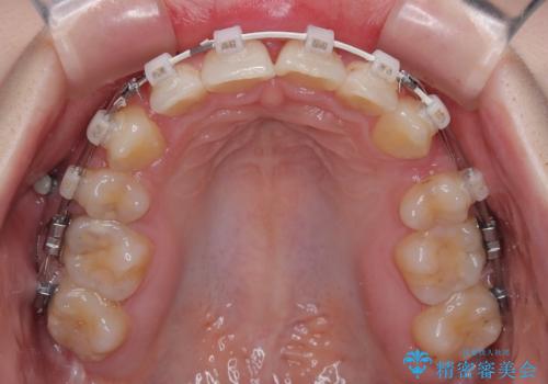 【モニター】デコボコと隠れてしまう前歯 ワイヤー装置による抜歯矯正で美しい口元にの治療中