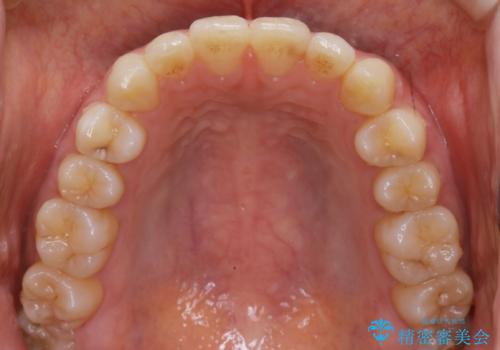【非抜歯】インビザラインの短期治療の治療後