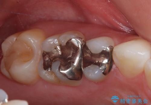 銀歯をやり替えたい セラミックインレー修復の症例 治療前