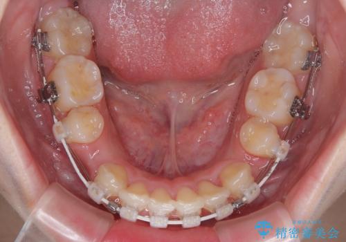 【モニター】デコボコと隠れてしまう前歯 ワイヤー装置による抜歯矯正で美しい口元にの治療中