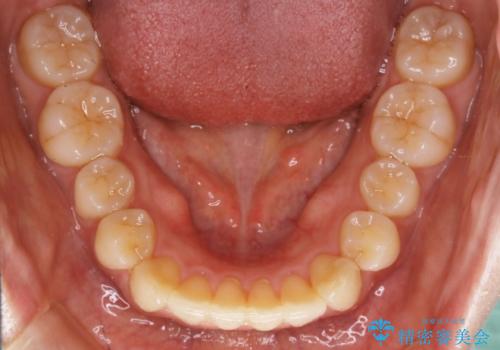 【非抜歯】インビザラインの短期治療