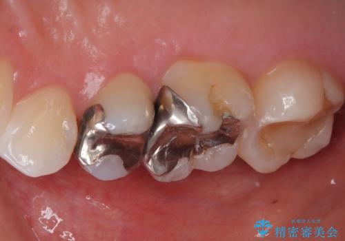 銀歯をやり替えたい セラミックインレー修復の治療前