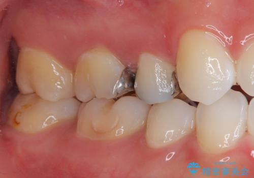 銀歯をやり替えたい セラミックインレー修復の治療前