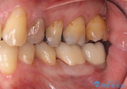 エンドペリオ病変と虫歯を同時に改善したインプラント・セラミック治療症例の治療後