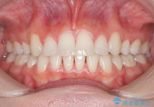 念願の白い歯をゲットの治療前