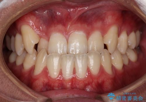 【審美装置】前歯の反対咬合改善の症例 治療前