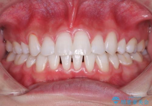 念願の白い歯をゲットの治療後