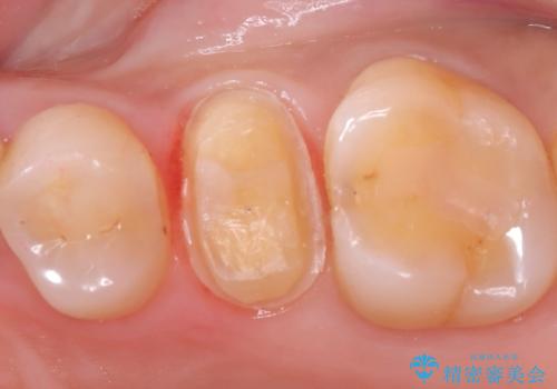 銀歯をやり替えたい 〈セラミッククラウン〉の治療中