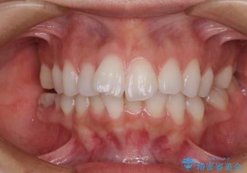 膨らんだ口元を改善する抜歯矯正 インプラント治療も同時に行う総合歯科治療の症例 治療前