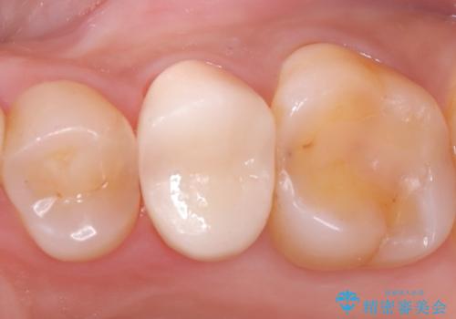 銀歯をやり替えたい 〈セラミッククラウン〉の症例 治療後