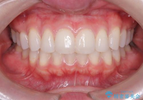 艶感アップになるクリーニングの治療前