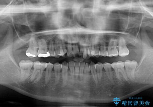 【モニター】前歯のデコボコをワイヤーの抜歯矯正で綺麗に整えるの治療前
