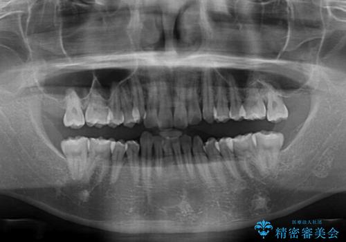 【モニター】八重歯とデコボコを治したい 補助装置を併用したワイヤー矯正の治療前