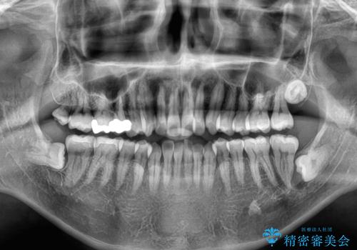 前歯のデコボコをささっと治す 短期間でのインビザライン矯正治療の治療前