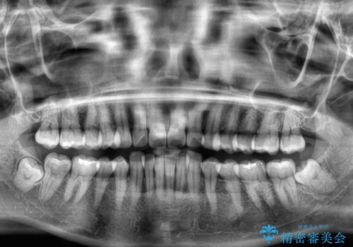 気になる前歯を短期間で治す インビザライン・モデレートでの矯正治療の治療前