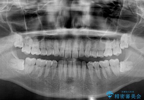 隙間だらけの歯列を治したい ワイヤー矯正での矯正治療の治療前