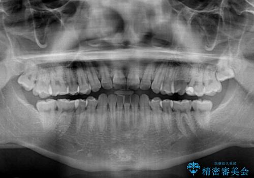 前歯のガタガタ・奥歯のかみ合わせ(シザーズバイト)を改善|1年半で完了したメタルブラケット矯正の治療前