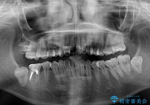 膨らんだ口元を改善する抜歯矯正 インプラント治療も同時に行う総合歯科治療の治療前