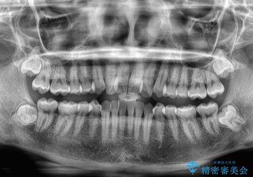 前歯のクロスバイト 裏側に隠れた歯をワイヤー装置で短期間治療の治療前