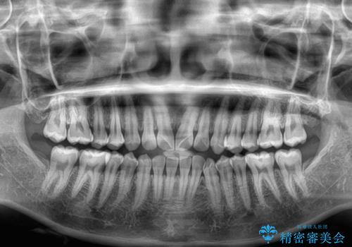 【モニター】マウスピース矯正が煩わしい ワイヤー装置での非抜歯矯正の治療前