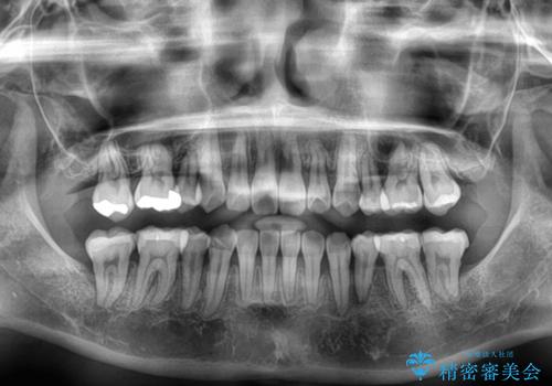 【モニター】前歯のデコボコをワイヤーの抜歯矯正で綺麗に整えるの治療後
