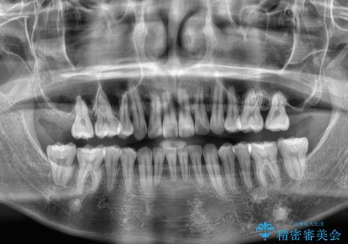 【モニター】八重歯とデコボコを治したい　補助装置を併用したワイヤー矯正の治療後