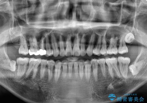 前歯のデコボコをささっと治す 短期間でのインビザライン矯正治療の治療後