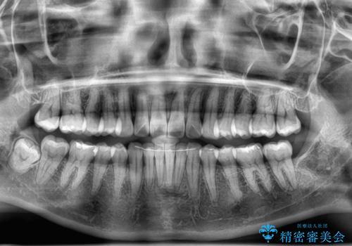 気になる前歯を短期間で治す インビザライン・モデレートでの矯正治療の治療後