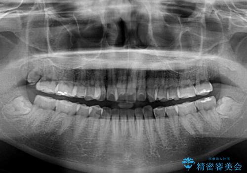 前歯のデコボコと口元の膨らみを治したい ワイヤー装置での非抜歯矯正の治療前