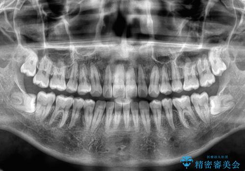 隙間だらけの歯列を治したい ワイヤー矯正での矯正治療の治療後
