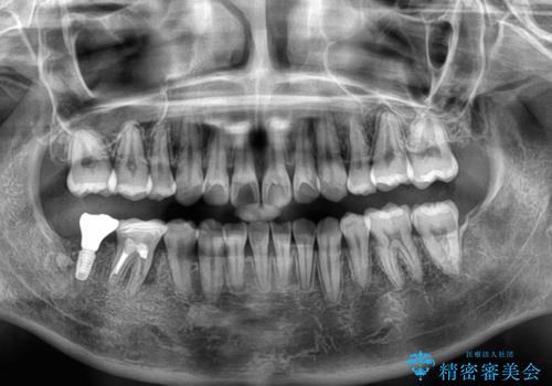 膨らんだ口元を改善する抜歯矯正 インプラント治療も同時に行う総合歯科治療の治療後