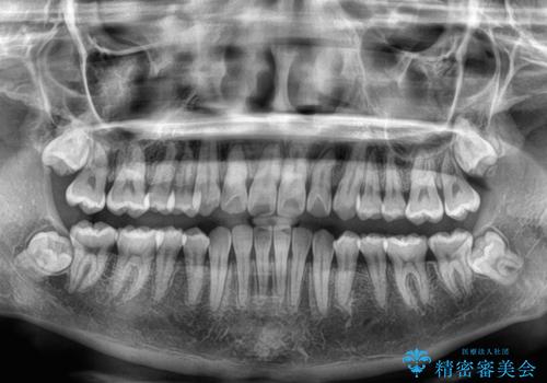 前歯のクロスバイト 裏側に隠れた歯をワイヤー装置で短期間治療の治療後