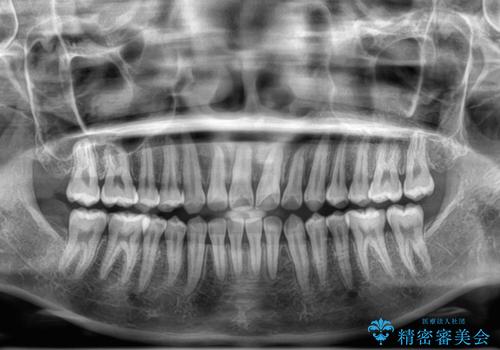 【モニター】マウスピース矯正が煩わしい ワイヤー装置での非抜歯矯正の治療後