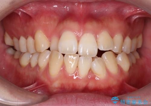 重度のデコボコも、インビザラインで改善の治療前