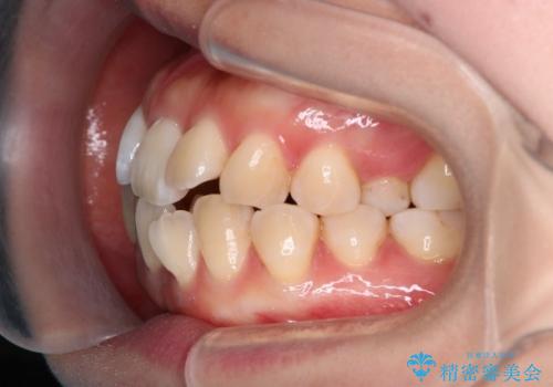 重度のデコボコも、インビザラインで改善の治療前