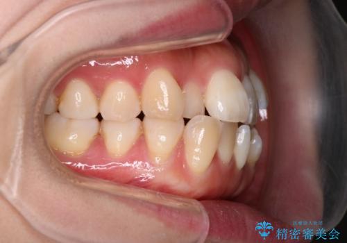 重度のデコボコも、インビザラインで改善の治療前