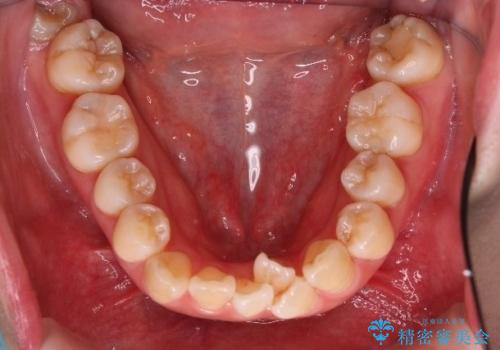 重度のデコボコも、インビザラインで改善の治療前