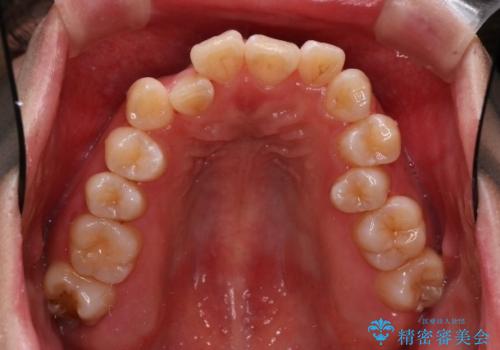 重度のデコボコも、インビザラインで改善の治療前