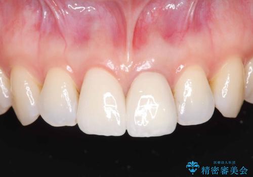 前歯の色が気になる!|他院で抜歯と言われた|歯を残したい|精密根管治療とオールセラミッククラウンで治療の治療後