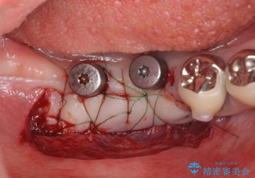 遊離歯肉移植術を伴うインプラント治療の治療中