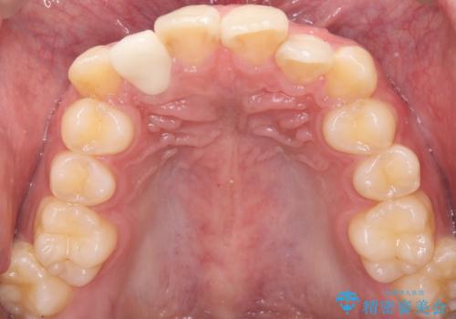 【セラミッククラウン】【精密根管治療】前歯が痛いの治療後