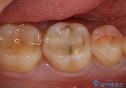 奥歯の虫歯を治療したい セラミックインレーの症例 治療前